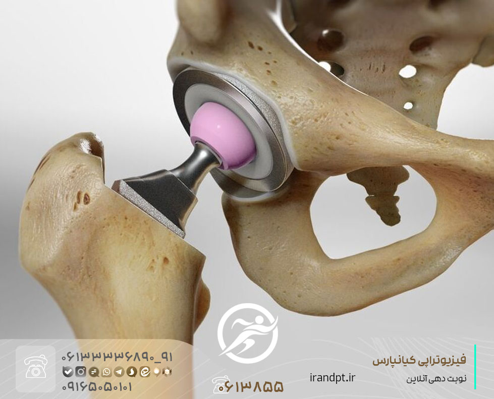 أهمية العلاج الطبيعي بعد خلع الورك