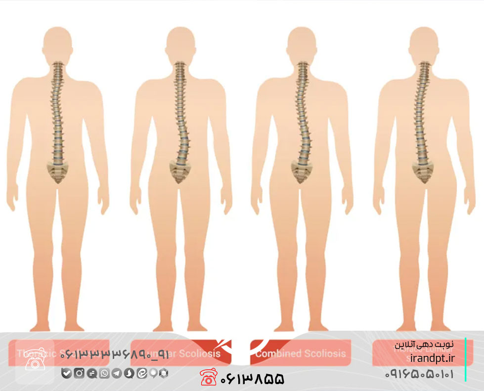 علاج انحراف العمود الفقري أو الجنف بالعلاج الطبيعي