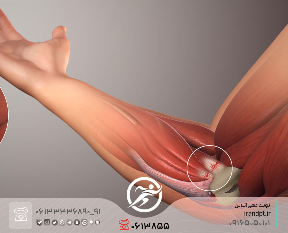 علاج ألم وتر الكوع الداخلي بالعلاج الطبيعي