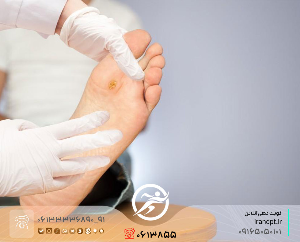 كيفية علاج القدم السكرية بالعلاج الطبيعي
