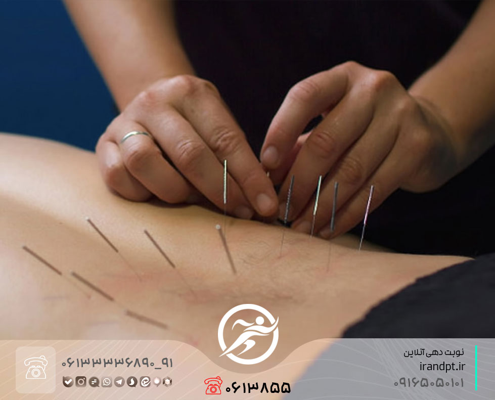 علاج تقلص العضلات بالنيدلينغ